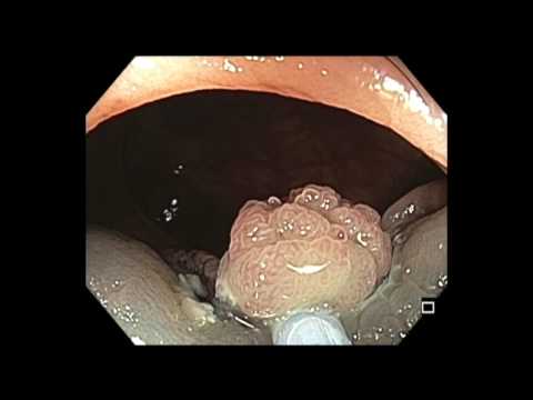 Colonoscopy: Transverse Colon EMR - Suction to Loosen Tissue