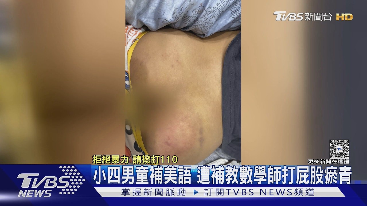 補英文卻被數學師抓去打！男童「屁股瘀青一片」家長淚崩提告