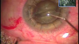 Download Lagu phaco cataract extraction, IOL in post-cornea transplant for advanced keratoconus: Kanellopoulos, MD Thumbnail