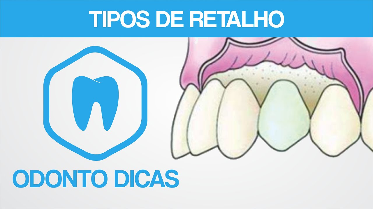 TIPOS DE RETALHO | ODONTO DICAS