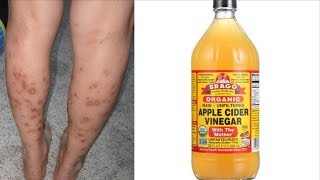 Home Remedies Series || Get Rid of Dark Spots On Legs & Body With Apple Cider Vinegar