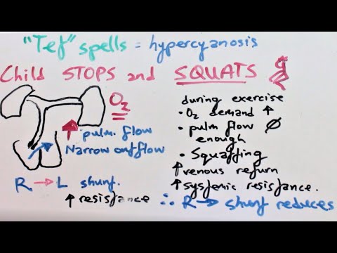 Tetralogy of Fallot: Presentation, Pathophysiology, Diagnosis & Treatment