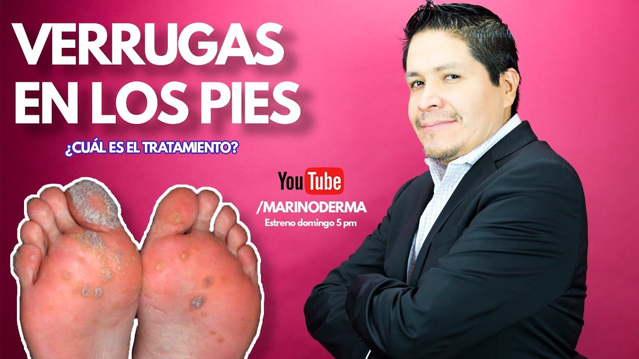 Watch VERRUGAS EN LOS PIES II ¿Por qué salen II ¿Cuál es el tratamiento Ft. Dr. Marino Dermatólogo Now VERRUGAS EN LOS PIES II ¿Por qué salen II ¿Cuál es el tratamiento Ft. Dr. Marino Dermatólogo