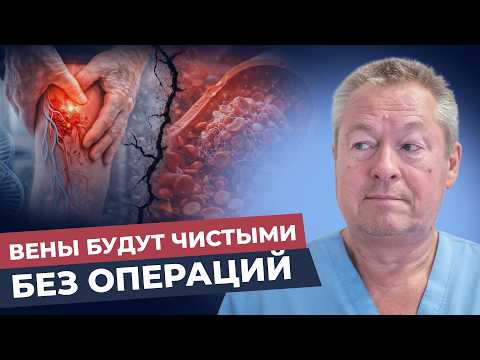 Как вылечить варикоз без операций: секрет здоровых вен