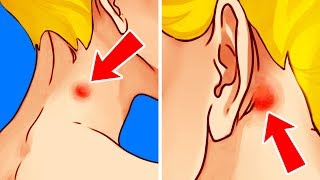 Si tienes un bulto en el cuello, revísalo lo antes posible