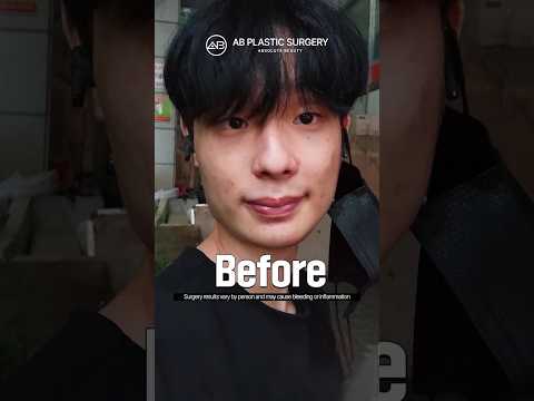 male plastic surgery before and after #shorts