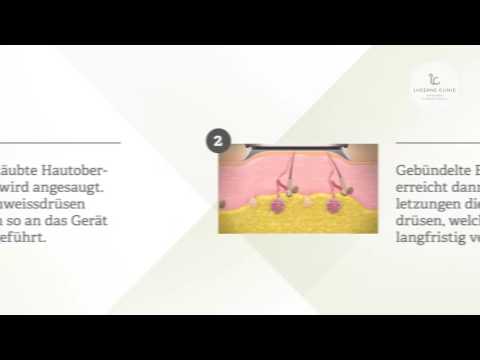 Achselschweiss – Miradry