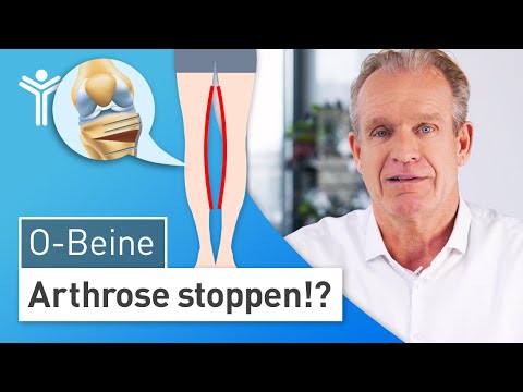 Bowlegs: What to do? | Everything you need to know about leg misalignment