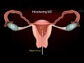 Intrauterine Device (IUD) Copper T Removal procedure - Patient Education Medical animation