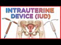 Intrauterine Device IUD Copper T Removal Procedure Patient Education Medical Animation