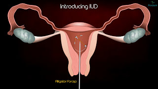 Intrauterine Device (IUD) Copper T Removal procedure - Patient Education Medical animation