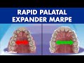 Rapid PALATAL Expander MARPE This ORTHODONTIC Device Can EXPAND The PALATE In Adults