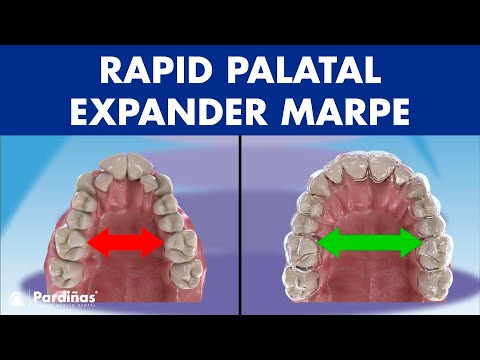 This ORTHODONTIC device can EXPAND the PALATE in adults