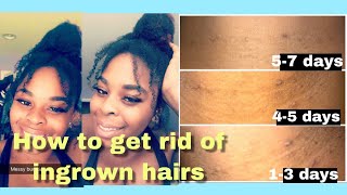 How to get rid of razor bumps and ingrown hairs in a week!