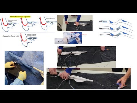 Rotational atherectomy: advanced techniques with videos + Orbital atherectomy tips- Elias Hanna