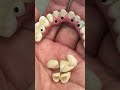 Superman Full Mouth Implants Zirconia
