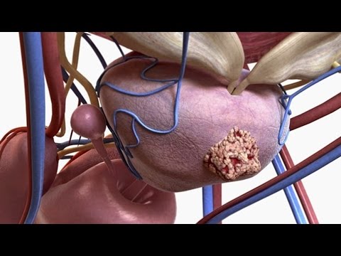 Haushaltsgeräte BPH Streptokokkus mitis Prostata