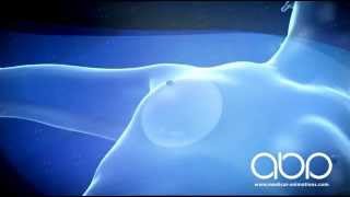 Keyhole breast implant surgery