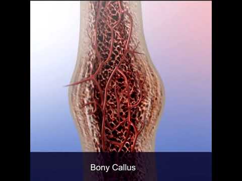 Bone Fractures: Proper Healing