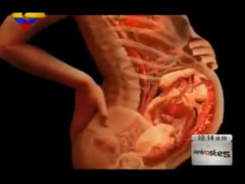 Hipertensión arterial diagnóstico diferencial síndrome Hipertensión angiopatía y cómo se expresa
