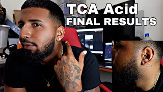 I Used TCA Acid on my Ears! Here are my FINAL RESULTS!