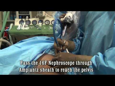 Ureteroscopia percutánea
