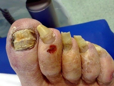Gribki die Candida beim Kind in der Kehle, wie zu behandeln Wie nogtewoj gribok in den Volksweisen zu heilen