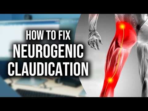 How Neurogenic Claudication Is Treated: Real Patient Story