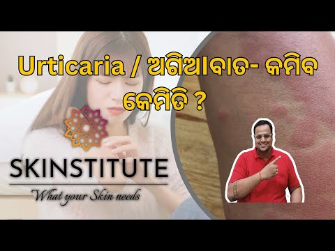 Urticaria / ଅଗିଅIବାତ- କମିବ କେମିତି ? Ft. Dr. Kumar Abhishek. SKINSTITUTE