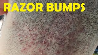how to get rid of razor bumps back of head