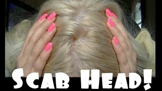 Girl Gets Burns From Bleaching Hair!?!