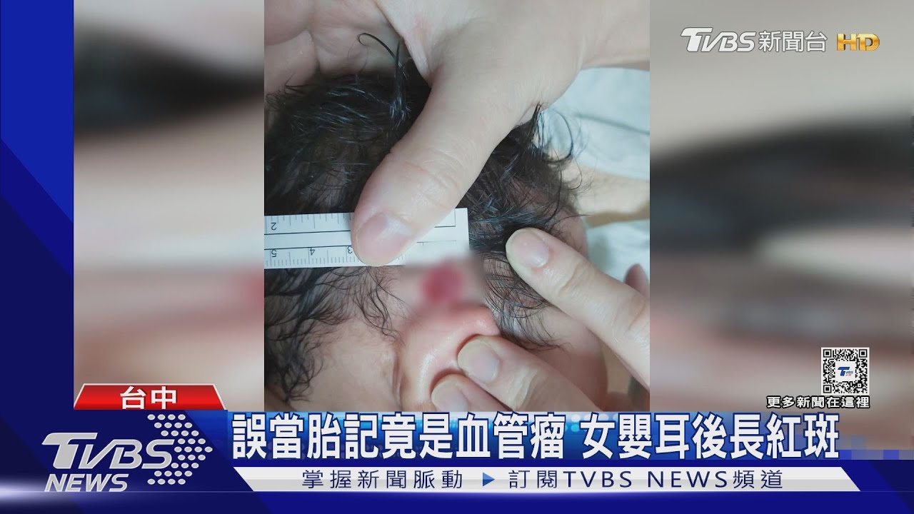 誤當胎記竟是血管瘤 女嬰耳後長紅斑