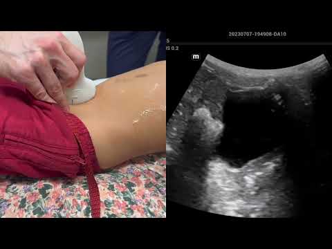 Pediatric Renal/Bladder scan demo: Trans into sagittal view