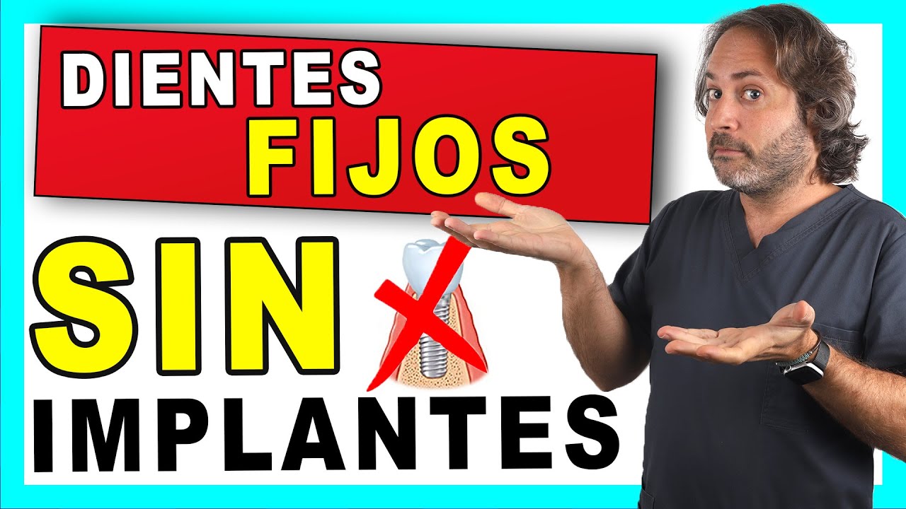 ¿𝗗𝗜𝗘𝗡𝗧𝗘𝗦 𝗙𝗜𝗝𝗢𝗦 𝗦𝗜𝗡 𝗜𝗠𝗣𝗟𝗔𝗡𝗧𝗘𝗦 dentales👍 Lo ÚLTIMO en PUENTES DENTALES Fijos de Zirconio