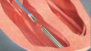How to Insert a Tiny Wireless Pacemaker Into a Human Heart