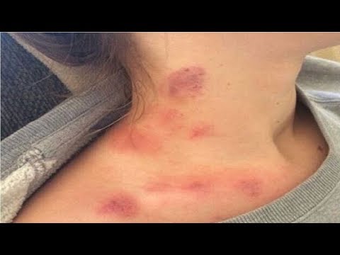 To give yourself a hickey on your neck with a spoon