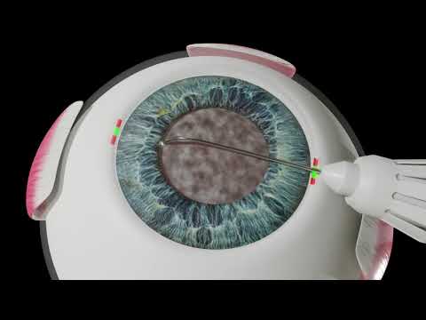 Wizualizacja operacji zaćmy