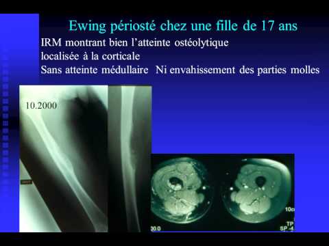 comment soulager les douleurs des metastases osseuses