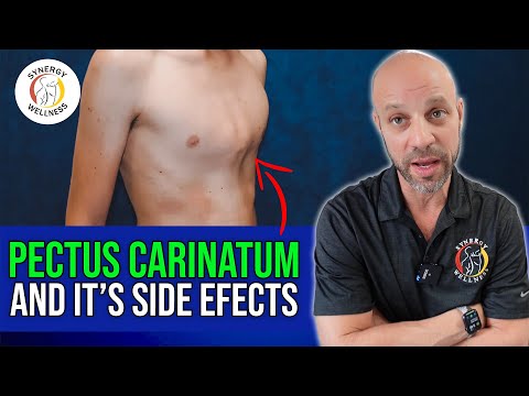 What Pectus Carinatum REALLY Means for Your Health?