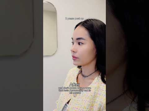 Revising a previous silicone implant rhinoplasty in 2-stages with rib cartilage #asianrhinoplasty