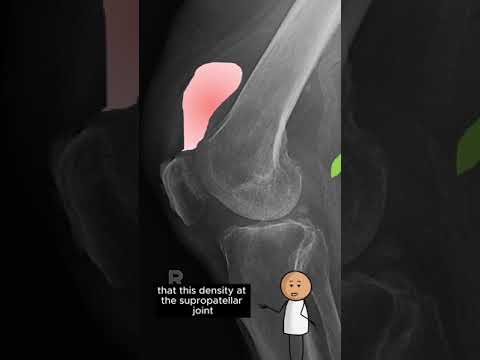 Knee Fat Pads and Supra Patellar Joint Effusion.