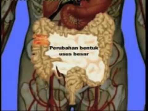 Patogen perempuan generik Diabetes dan impotensi