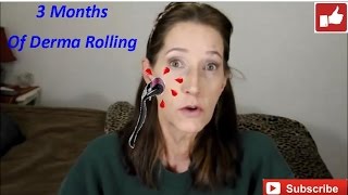 3 Months of Dermarolling w/ before and after pictures!!!