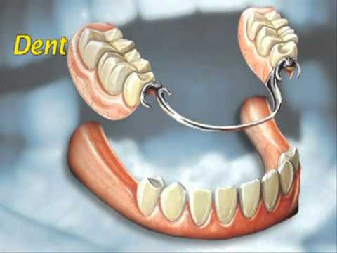 Dental Education Tooth Replacement  Options