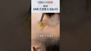 흑자와 기미 구분, 레이저 치료 전 정확한 진단