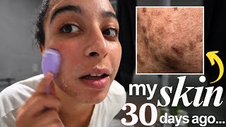 30 days to CLEAR hyperpigmentation: my authentic journey to GLASS SKIN (*reality check)