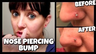 How To Get Rid Of A Nose Piercing Bump FAST! | (Keloid)  📍 How To With Kristin