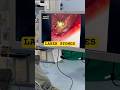 LASER SE STONE PATHRI KA OPERATION KAISE HOTA HAI Kidney Stones Treatment