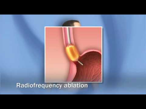 Treatments for Barrett's Esophagus, Dysplasia, Esophagus Cancer (adenocarcinoma) - Mayo Clinic