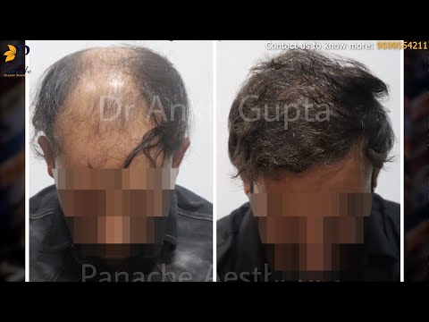 Hair Transplant Patient Review